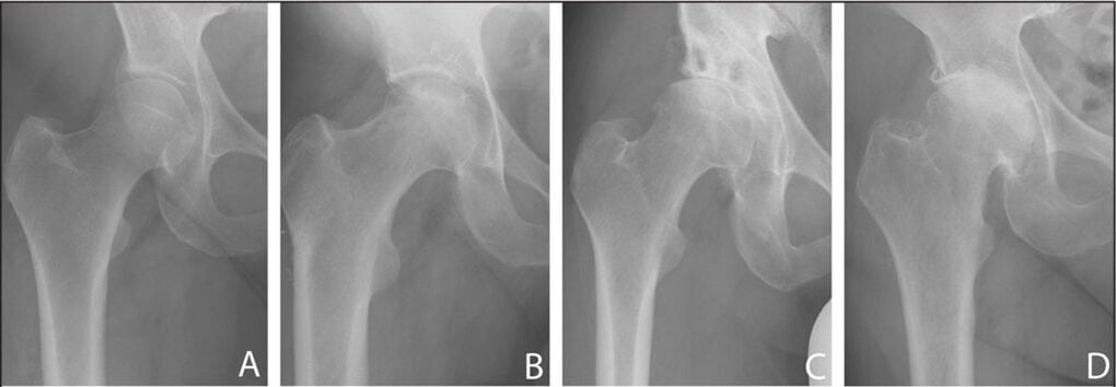 Etapas de desarrollo de la osteoartritis de la articulación de la cadera en radiografías. 