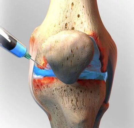 Tratamiento de la osteoartritis