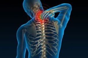 La osteocondrosis cervical conduce al dolor en el cuello
