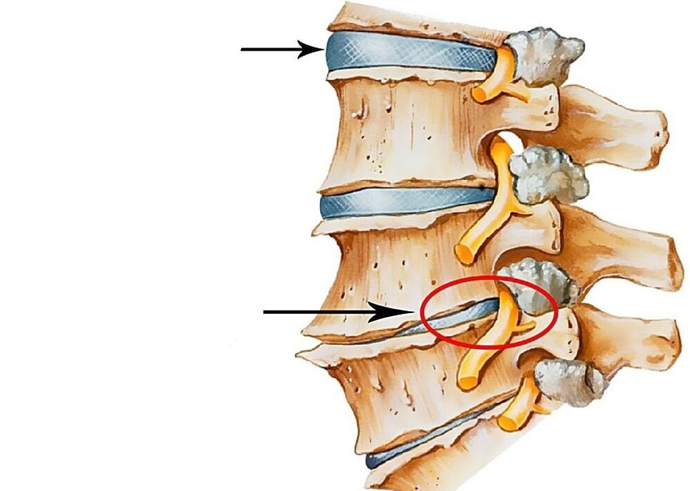 Representación de discos intervertebrales sanos y deformados.