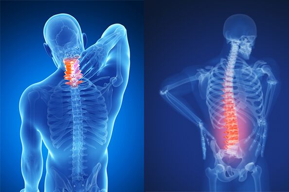 Osteocondrosis de la columna cervical y lumbar.