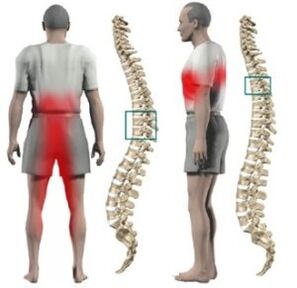 Protuberancias en la columna