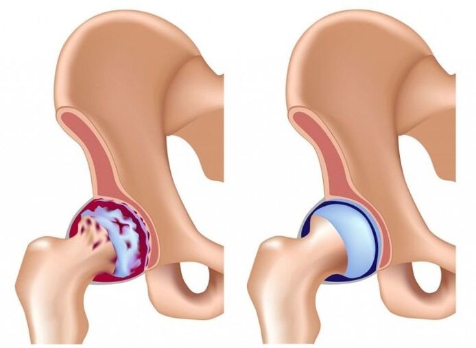 Daño a la articulación de la cadera debido a la osteoartritis.