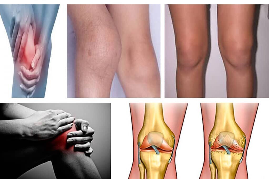 Osteoartritis, ¿qué es