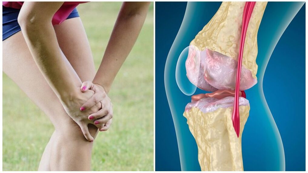 Síntomas de la osteoartritis