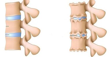 Cómo reconocer la presencia de osteocondrosis de la columna lumbar