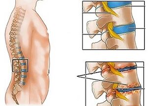 Las causas de la osteocondrosis de la columna lumbar