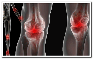 Los síntomas de la osteoartritis. 