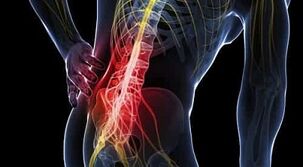 Causas del dolor de espalda